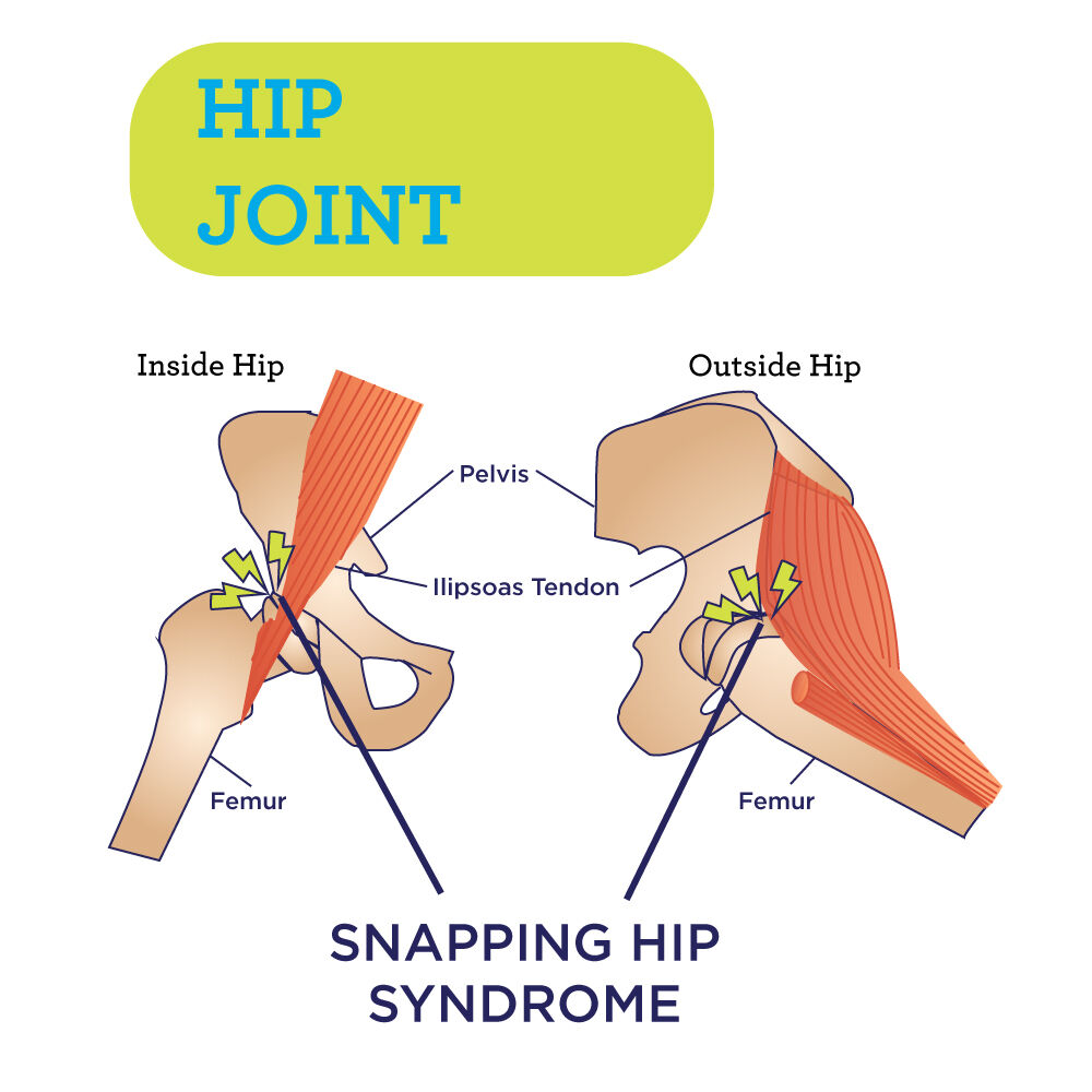 Snapping-Hip-Syndrome.jpg
